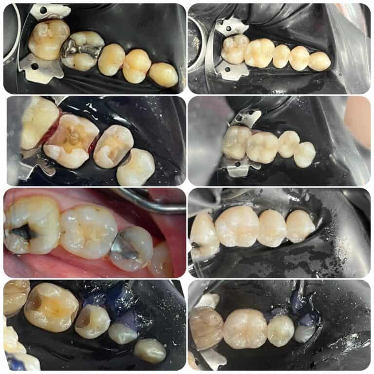 Fotokompozitné výplne